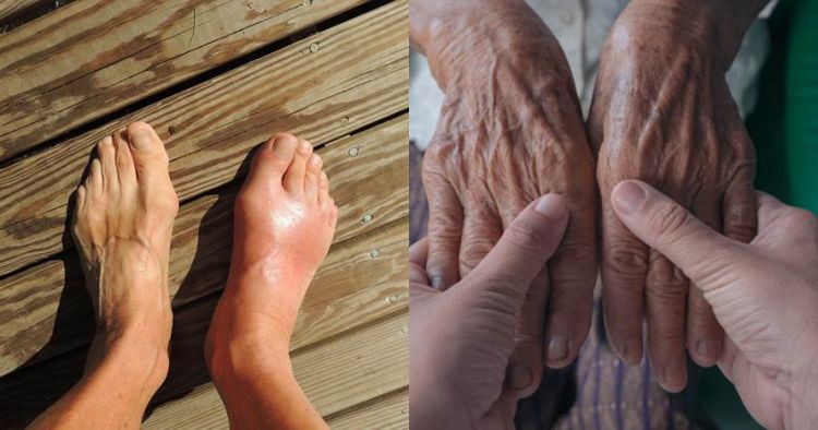 Cara Mengatasi Asam Urat